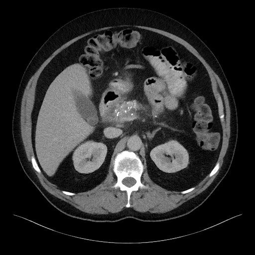 Acute-on-chronic pancreatitis (Radiopaedia 67286-76656 Axial C+ portal venous phase 27).jpg