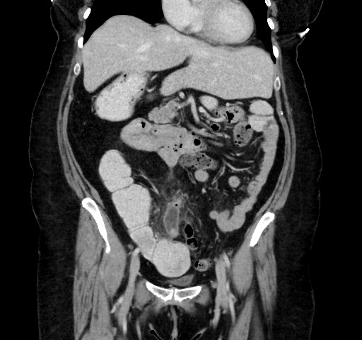 Acute appendicitis, heterotaxy syndrome (Radiopaedia 66884-76202 Coronal C+ portal venous phase 51).jpg