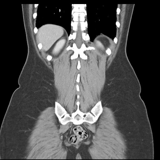 Acute appendicitis (Radiopaedia 30297-30934 Coronal C+ portal venous phase 39).jpg