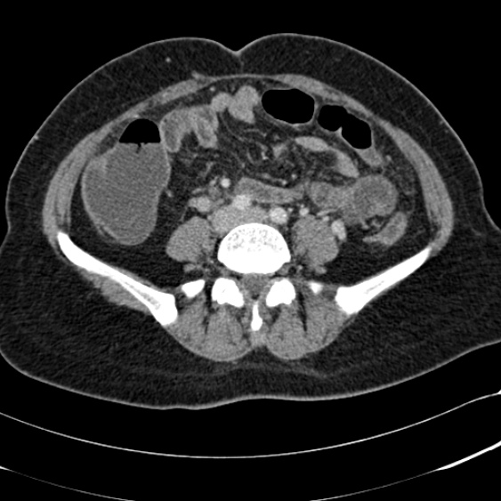 File:Acute appendicitis (Radiopaedia 48792-53822 Axial C+ portal venous phase 72).jpg
