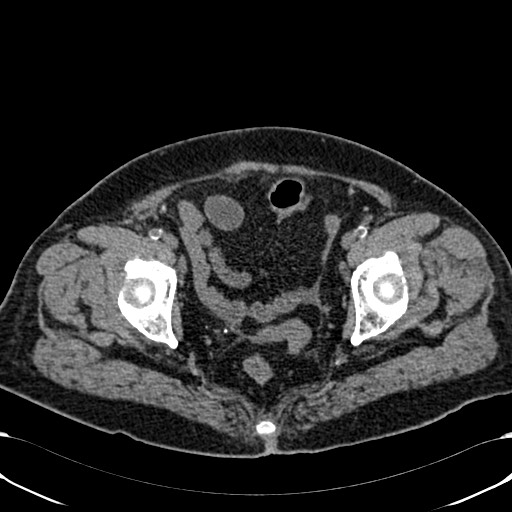 Acute appendicitis (Radiopaedia 58627-65818 Axial non-contrast 79).jpg