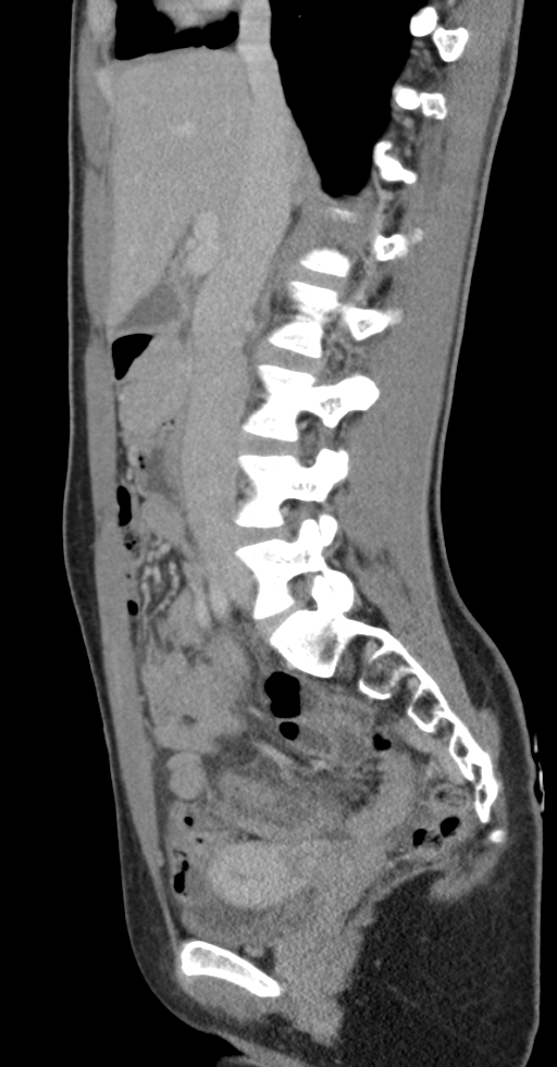 Acute appendicitis (Radiopaedia 62608-70901 Sagittal C+ portal venous phase 27).jpg