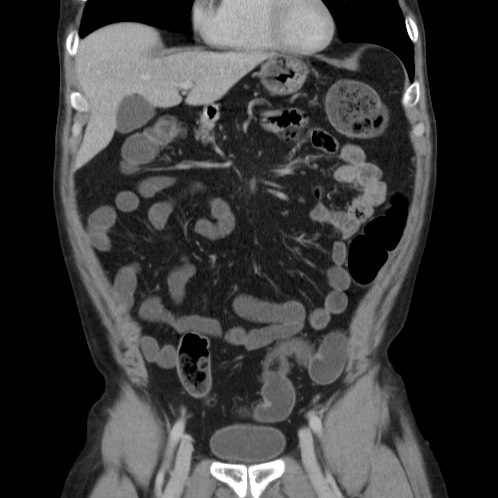 Acute appendicitis (Radiopaedia 66513-75790 Coronal C+ portal venous phase 19).jpg