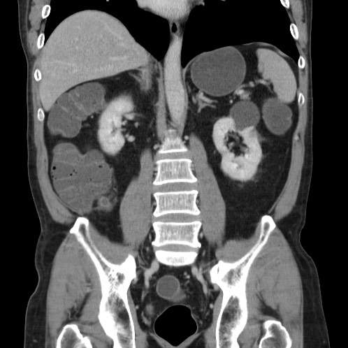 Acute appendicitis (Radiopaedia 66513-75790 Coronal C+ portal venous phase 52).jpg