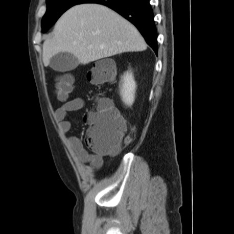 File:Acute appendicitis (Radiopaedia 66513-75790 Sagittal C+ portal venous phase 31).jpg
