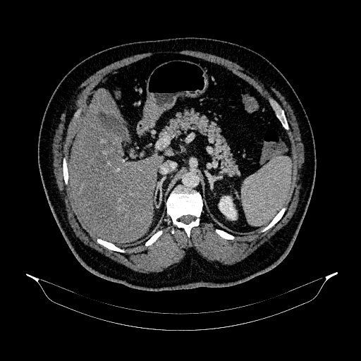 Acute appendicitis (Radiopaedia 79950-93224 Axial C+ portal venous phase 32).jpg
