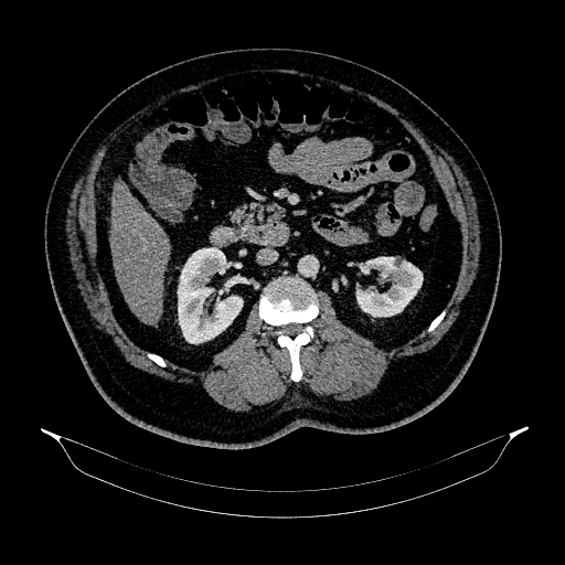 Acute appendicitis (Radiopaedia 79950-93224 Axial C+ portal venous phase 46).jpg