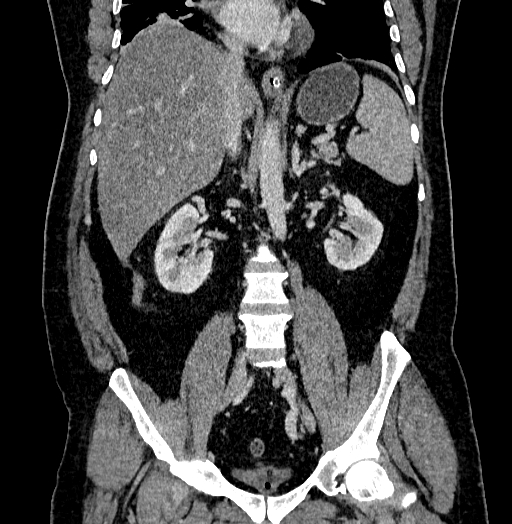 Acute appendicitis (Radiopaedia 79950-93224 Coronal C+ portal venous phase 53).jpg
