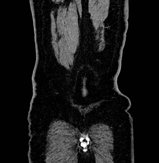 Acute appendicitis (Radiopaedia 79950-93224 Coronal C+ portal venous phase 95).jpg