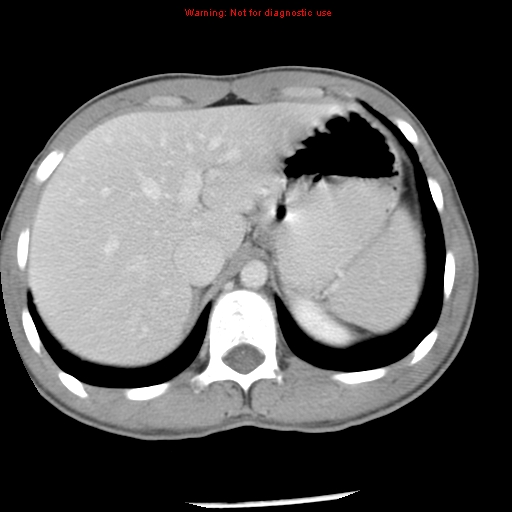 Acute appendicitis (Radiopaedia 8195-9045 Axial C+ portal venous phase 14).jpg