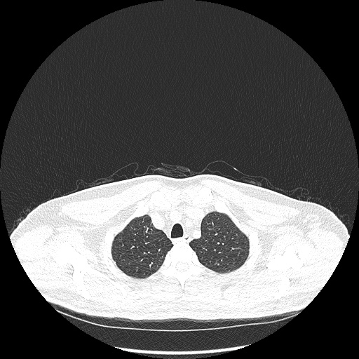 Acute appendicitis and COVID 19 pneumonia (Radiopaedia 76604-88380 Axial lung window 11).jpg