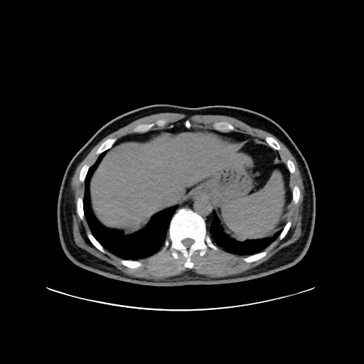 Acute appendicitis and COVID 19 pneumonia (Radiopaedia 76604-88380 Axial non-contrast 49).jpg