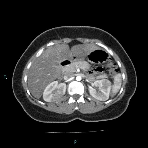 Acute bilateral pyelonephritis (Radiopaedia 37146-38881 Axial C+ arterial phase 64).jpg