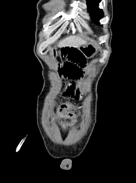 Acute bowel ischemia (Radiopaedia 87695-104114 Coronal C+ portal venous phase 81).jpg