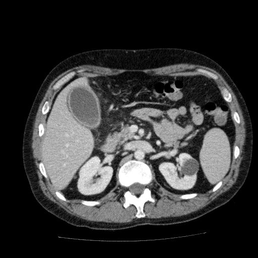 File:Acute cholecystitis and incidental left sided IVC (Radiopaedia 49352-54459 Axial C+ portal venous phase 59).jpg