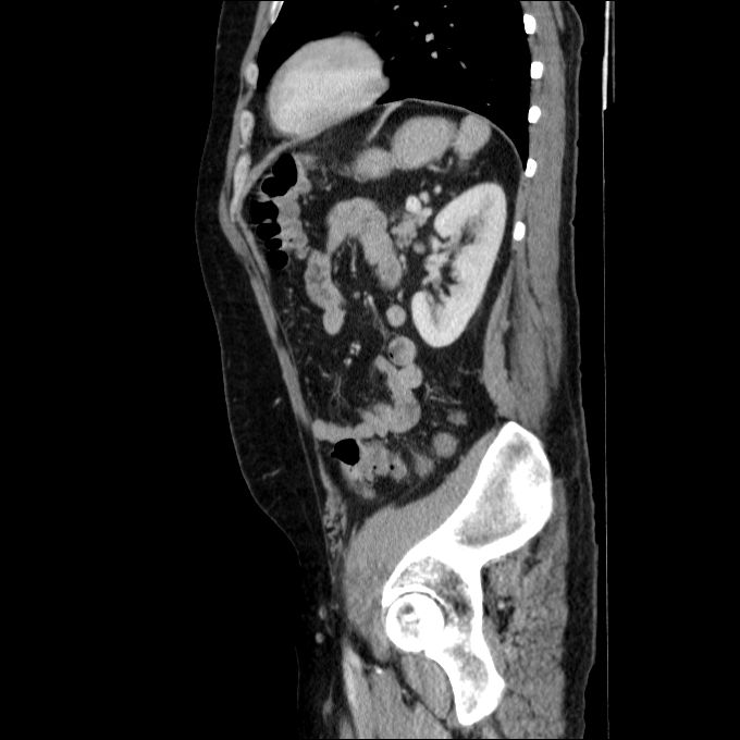 Acute cholecystitis and incidental left sided IVC (Radiopaedia 49352-54459 Sagittal C+ portal venous phase 30).jpg