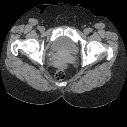Acute cholecystitis and ureteric colic (Radiopaedia 42330-45444 Axial prone 107).jpg