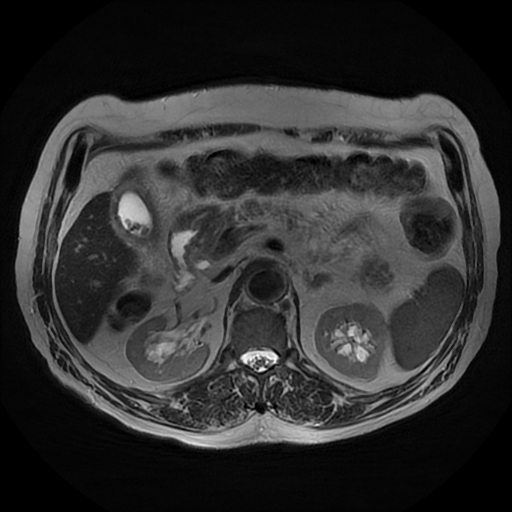 File:Acute cholecystitis complicated by pylephlebitis (Radiopaedia 65782-74915 Axial T2 20).jpg