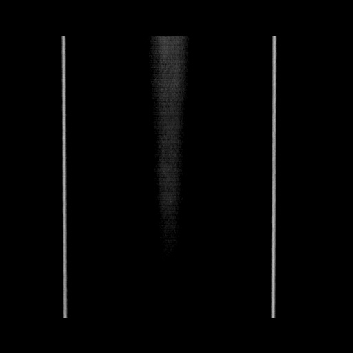 File:Acute cholecystitis with tensile fundus sign (Radiopaedia 71394-81723 Coronal non-contrast 140).jpg