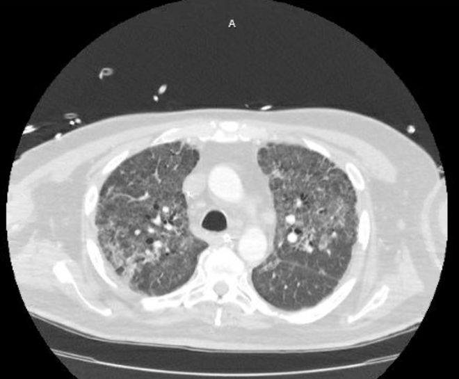 Acute cor pulmonale (ultrasound) (Radiopaedia 83508-98818 Axial lung window 30).jpg
