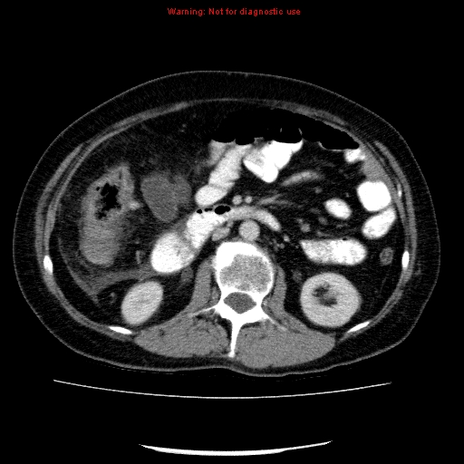 Acute gangrenous cholecystitis (Radiopaedia 10123-10661 Axial C+ portal venous phase 46).jpg