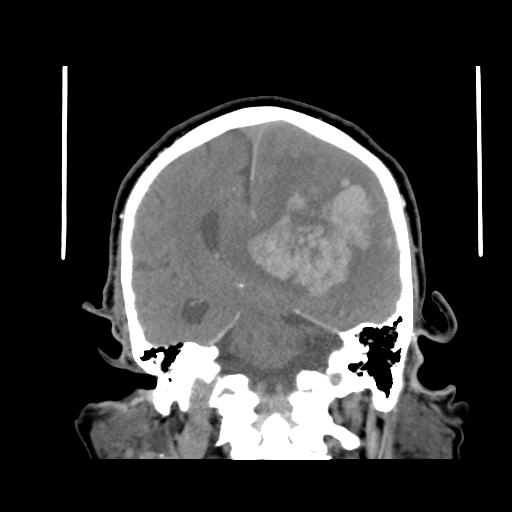 File:Acute hemorrhagic stroke (Radiopaedia 17507-17223 Coronal non-contrast 32).jpg