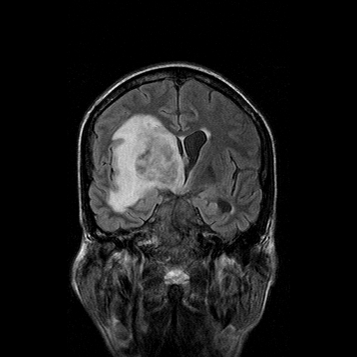 File:Acute necrotizing toxoplasma encephalitis (Radiopaedia 10683-11149 Coronal FLAIR 11).jpg