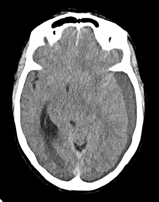 Acute on chronic subdural hematoma (Radiopaedia 74814-85823 Axial non-contrast 42).jpg