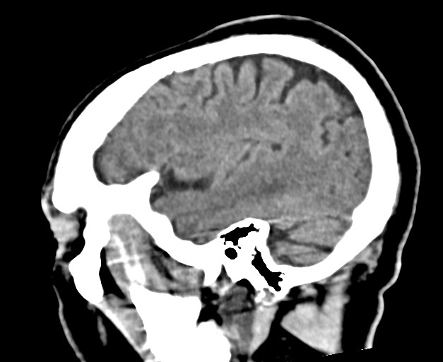 Acute on chronic subdural hematoma (Radiopaedia 78346-90966 Sagittal non-contrast 16).jpg