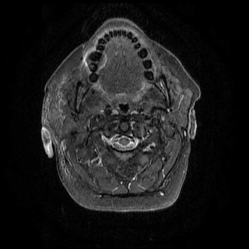 File:Acute otitis externa (Radiopaedia 57296-64236 Axial STIR 14).jpg