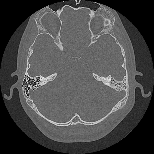 Acute otomastoiditis and Bezold abscess (Radiopaedia 88184-104786 Axial bone window 43).jpg