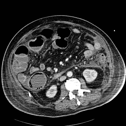 Acute pancreatic necrosis (Radiopaedia 13560-18502 Axial C+ portal venous phase 53).jpg