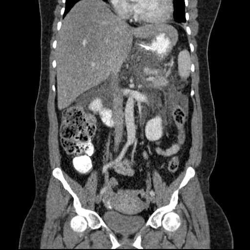 File:Acute pancreatitis (Radiopaedia 20829-20744 Coronal C+ portal venous phase 29).jpg