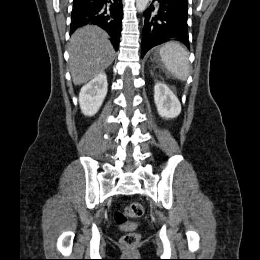 File:Acute pancreatitis (Radiopaedia 20829-20744 Coronal C+ portal venous phase 41).jpg