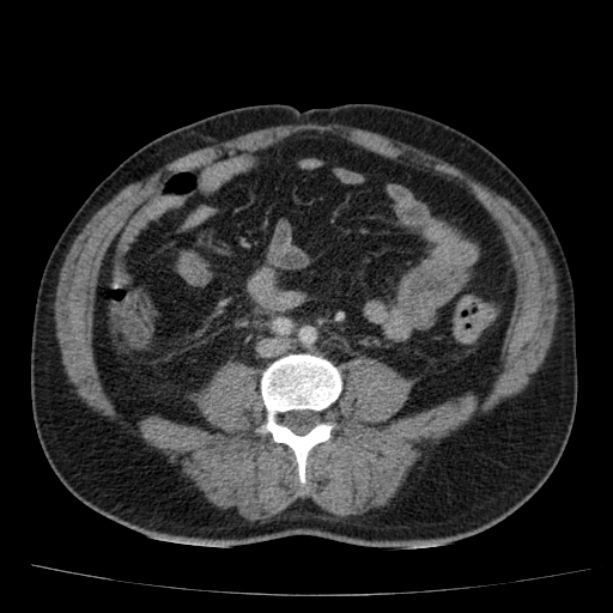 Acute pancreatitis (Radiopaedia 26663-26813 Axial C+ portal venous phase 54).jpg