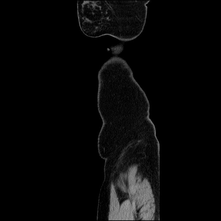 Acute pancreatitis (Radiopaedia 69236-79012 Sagittal C+ portal venous phase 10).jpg