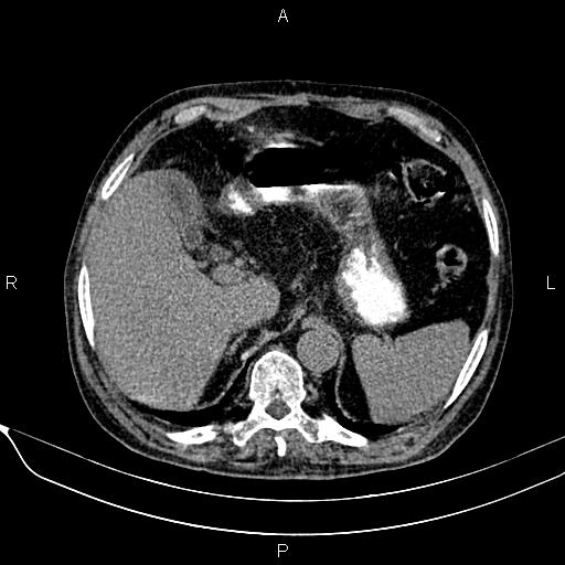File:Acute pancreatitis (Radiopaedia 85146-100701 Axial non-contrast 32).jpg