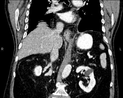 Acute pancreatitis (Radiopaedia 85146-100701 Coronal C+ portal venous phase 45).jpg