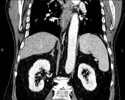 Acute pancreatitis (Radiopaedia 85146-100701 Coronal C+ portal venous phase 50).jpg
