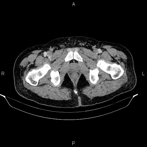 Acute pancreatitis (Radiopaedia 85390-101010 Axial C+ portal venous phase 112).jpg