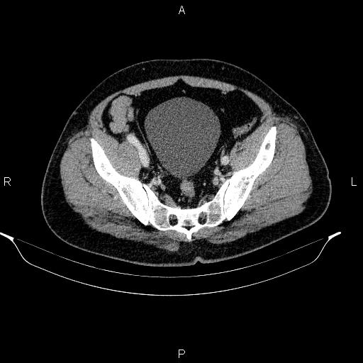 Acute pancreatitis (Radiopaedia 85390-101010 Axial C+ portal venous phase 89).jpg