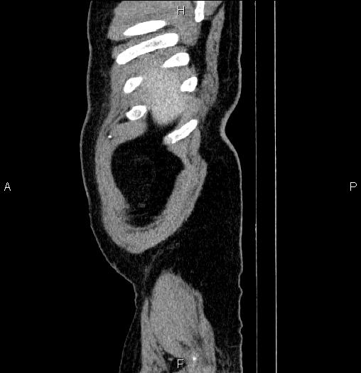 Acute pancreatitis (Radiopaedia 85390-101010 Sagittal C+ portal venous phase 1).jpg