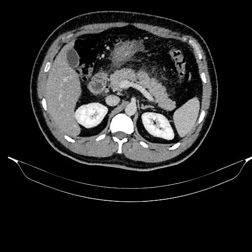 Acute pancreatitis (Radiopaedia 87428-103757 Axial C+ portal venous phase 36).jpg