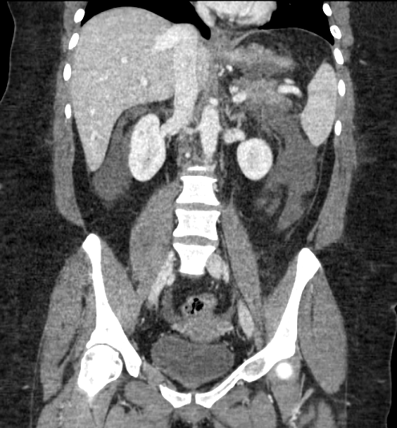 Acute pancreatitis - Balthazar E (Radiopaedia 29016-29377 Coronal C+ portal venous phase 54).png