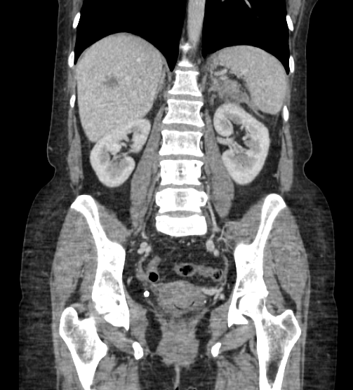 Acute pancreatitis - Balthazar E - post ERCP (Radiopaedia 27562-27772 Coronal C+ portal venous phase 56).png