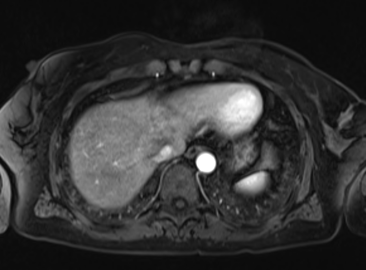 Acute pancreatitis - Balthazar E - post ERCP (Radiopaedia 27562-27778 Axial VIBE C+ 15).png