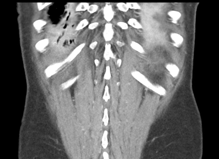 File:Acute pancreatitis and walled-off necrosis (Radiopaedia 29888-30404 Coronal C+ portal venous phase 46).jpg
