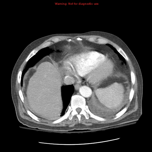 File:Acute pancreatitis with incidental pancreatic lipoma (Radiopaedia 10190-10730 Axial C+ arterial phase 13).jpg