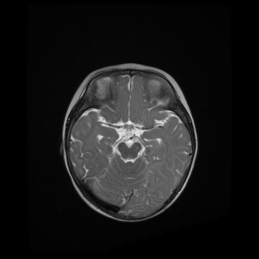 File:Acute phase of hemiconvulsion-hemiplegia epilepsy syndrome (Radiopaedia 29309-29745 Axial T2 15).jpg