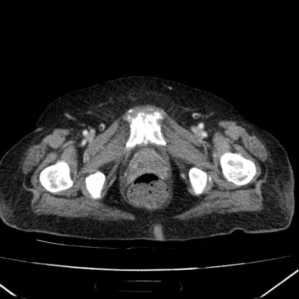 Acute pyelonephritis (Radiopaedia 26584-26729 Axial renal cortical phase 76).jpg